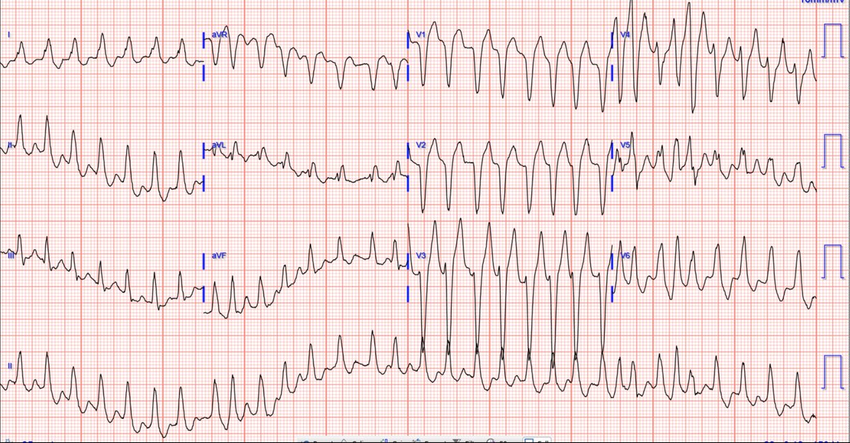 Stephen W. Smith (@smithecgblog) on Twitter photo A young man with another episode of tachycardia. What is it? And why give adenosine in sinus rhythm?  <a href="/PendellM/">Pendell Meyers</a> 
hqmeded-ecg.blogspot.com/2023/06/a-youn… A young man with another episode of tachycardia. What is it? And why give adenosine in sinus rhythm?  <a href="/PendellM/">Pendell Meyers</a> 
hqmeded-ecg.blogspot.com/2023/06/a-youn…
