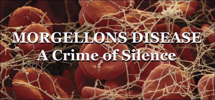 UeldomDiniz's tweet image. Os Morgellons  são simplesmente Filamentos de Grafeno, que são mais conhecidos por "Nanotubos  de Carbono”. #Chemtrails #Haarp #Morgellons #Grafeno #RastrosQuimicos #Bario #Mercurio #Estroncio #NWO #Matrix