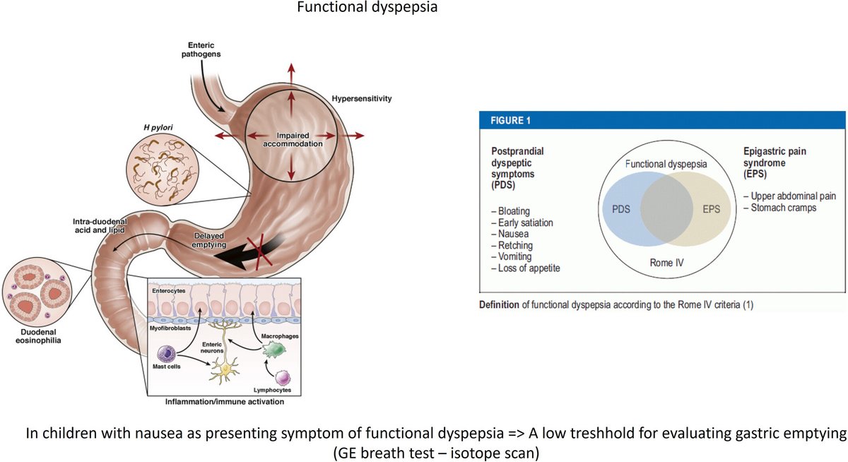 💡@NGMJournal
✅#Nausea is the only symptom associated with #DelayedGastricEmptying in pediatric #FunctionalDyspepsia patients
✅Overall #SymptomSeverity in patients with delayed GE was similar to symptoms of patients with a normal GE rate
@TARGID_KULEUVEN @ANMSociety @esnm_eu…