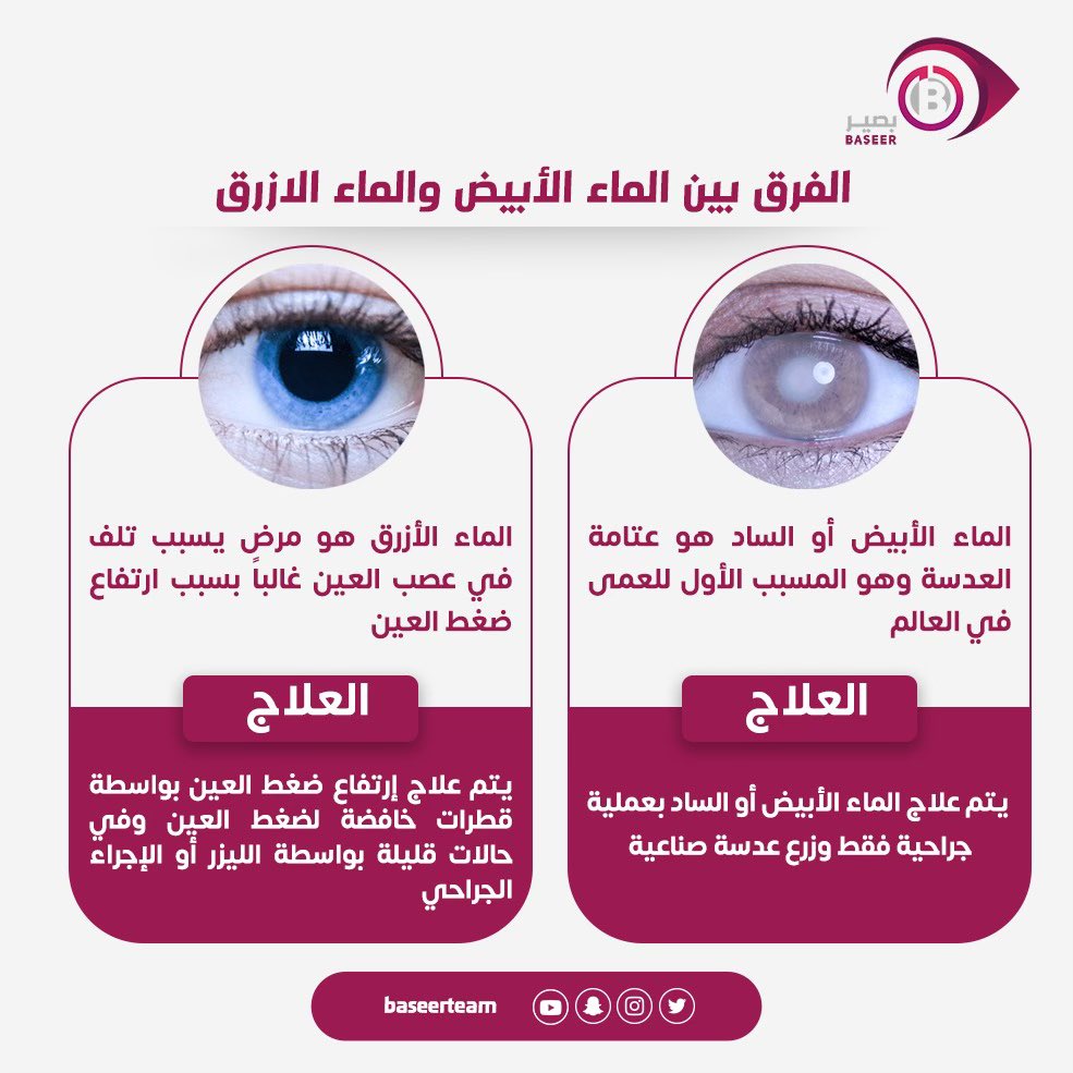baseerteam's tweet photo. ⁉️⁉️⁉️⁉️⁉️

ما الفرق بين الماء الابيض (الساد) و الماء الازرق (الجلوكوما)؟! https://t.co/AZmr1QPACi