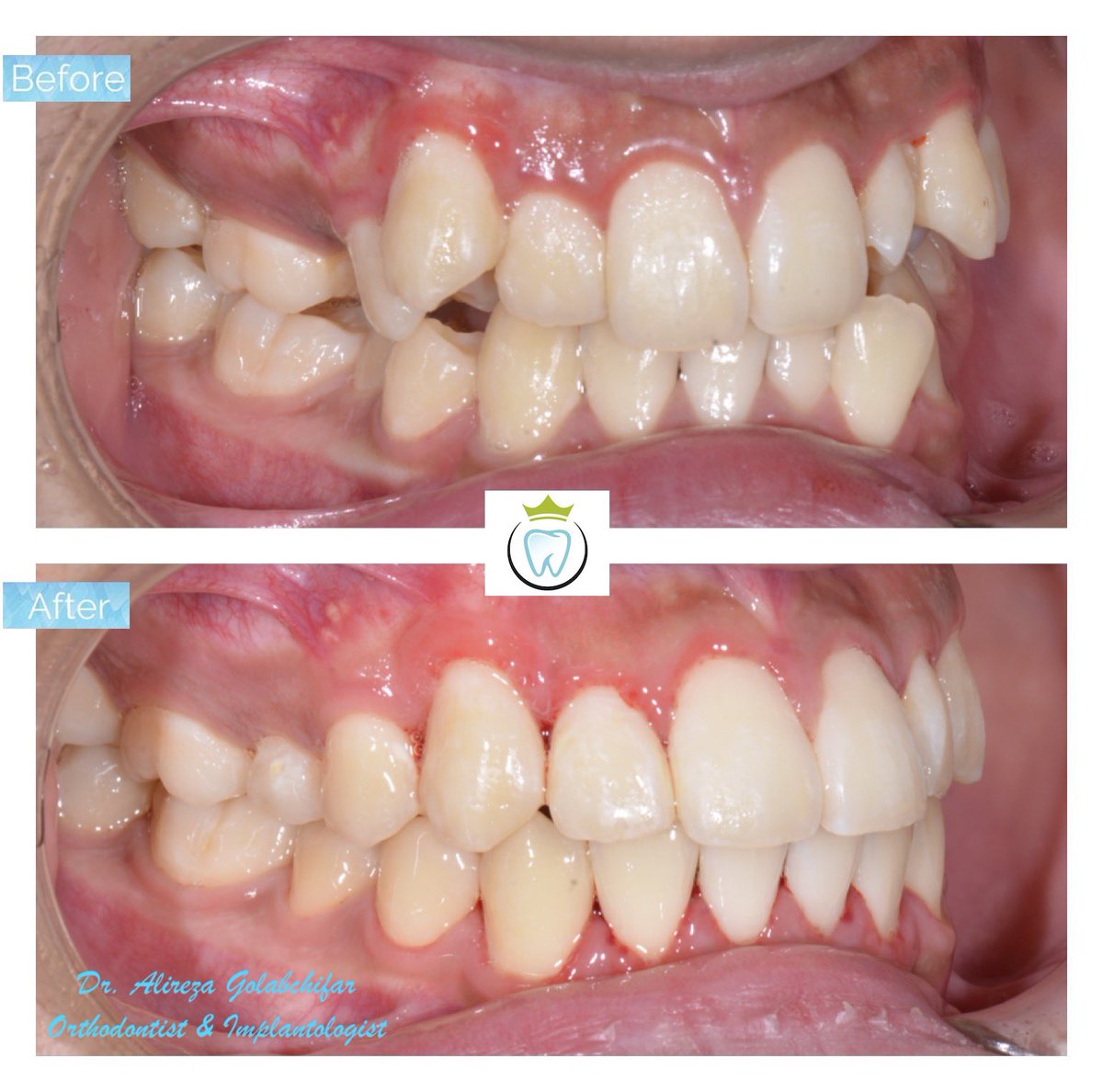 dentistry_king's tweet photo. Check out this amazing #braces result!! 
With the use of upper and lower clear braces were able to correct this bite and alleviate crowding.
Resulting in a beautiful smile!!

#orthodontics #braces #smile #smiletransformation #cosmeticdentistry #orthosmile https://t.co/VwouP1nXlH