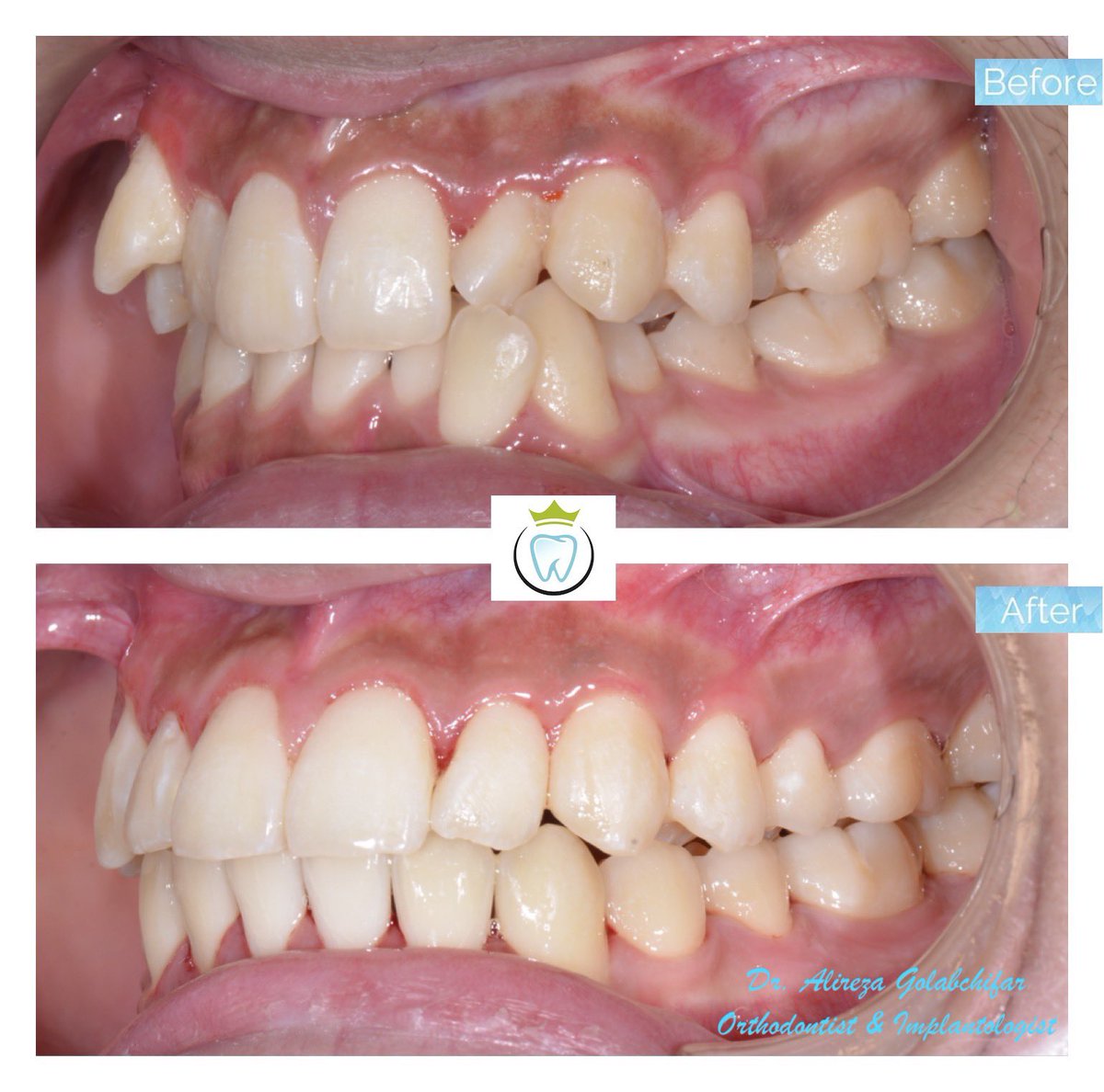 dentistry_king's tweet photo. Check out this amazing #braces result!! 
With the use of upper and lower clear braces were able to correct this bite and alleviate crowding.
Resulting in a beautiful smile!!

#orthodontics #braces #smile #smiletransformation #cosmeticdentistry #orthosmile https://t.co/VwouP1nXlH
