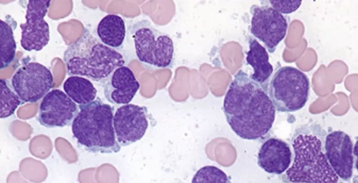 #Amigotweetorials
1/
Short Case
40M
Presents with Abdominal Pain 
You see a Lymphocytosis on Bloods 
Under the Microscope🔽
#MedTwitter #hemetwitter #hemepath