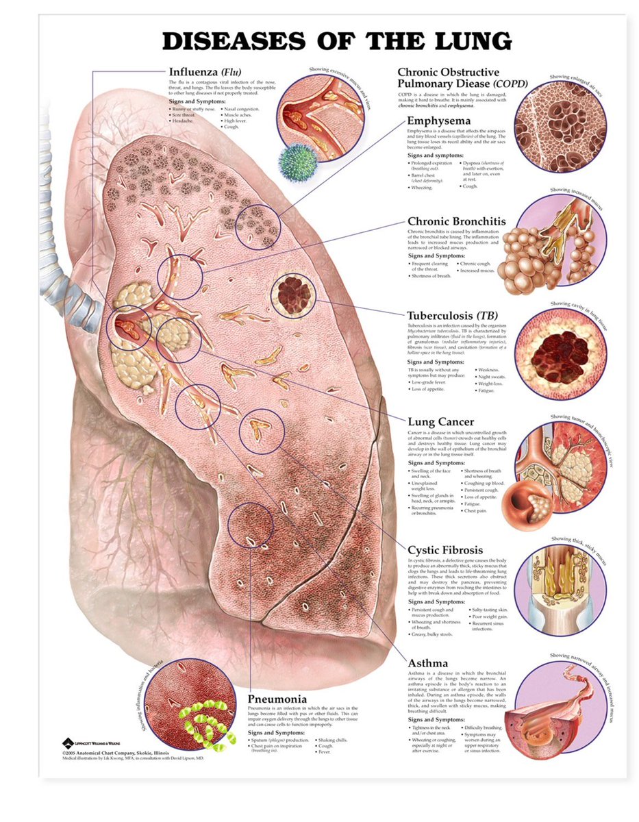 Innov_Medicine's tweet photo. The respiratory system and  disorders
#pulmtwitter #meded #metwitter https://t.co/F8cj2qLEbX