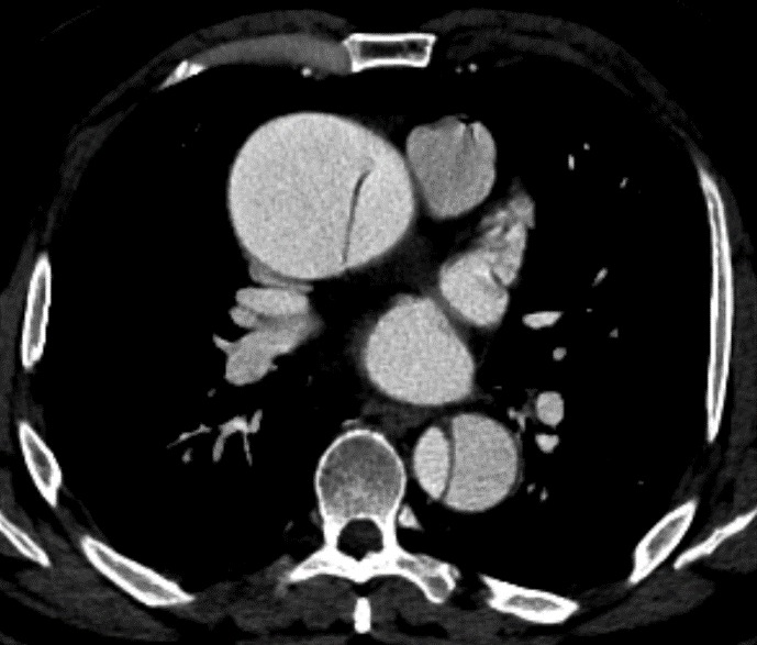 Aortic dissection type A
4 important CT findings to identify:
🟢 Intimal TEAR
🟡 Intimal FLAP
🟣 True lumen
🔵 False lumen
The location of the tear will determine the aortic dissection type (A or B) wich is key to choose treatment strategy🩺
#radiology #radtwitter #FOAMrad