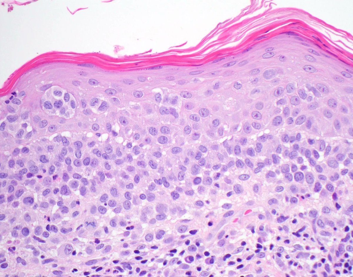 JMGardnerMD's tweet photo. Can you make the diagnosis from one pic, or is it #TooCloseToDiagnose?
S100 &amp; BRAF positive; MART-1 &amp; SOX-10 negative.
Answer &amp; more pics: https://t.co/xOGE0x6VhD 
Video: https://t.co/lALcaj3YaM 
#pathology #pathologists #pathTwitter #dermpath #dermatology #dermtwitter https://t.co/reU0I14w97