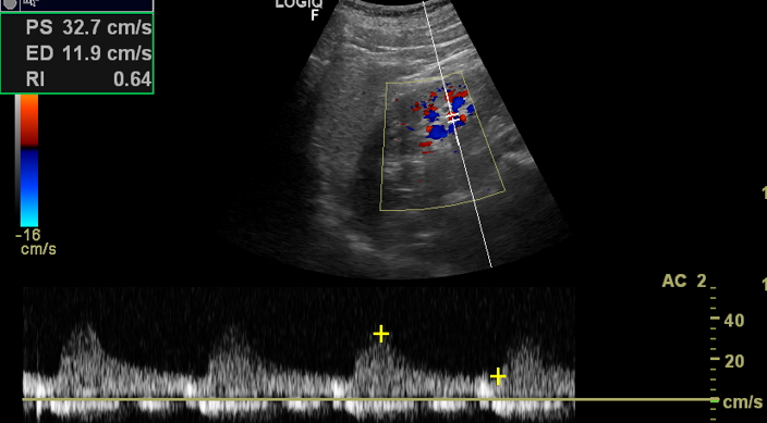 #sonography #radiology #interventionalradiology  #MedTwitter 
Clinical #POCUS quiz:
76-year-old pt., right functional single kidney already treated with PTRA + stent...
Now uncontrolled hypertension and creatinine🆙
What's happening ??🤨