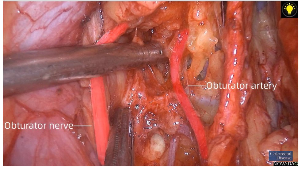ColorectalDis's tweet image. #CoDiSundays📖☕️

@escp_tweets and @ColorectalDis watch🍿📽️🎞️  #ICG guided left lateral node dissection

#SoMe4Surgery #colorectalcancer #colorectalsurgery

@ASCRS_1 @SAGES_Updates @CRSVirtualEd @HumanitasCRS @ESSOnews 

Watch here with us👇
youtube.com/watch?v=ZgiosB…