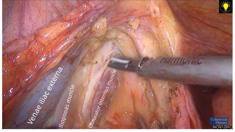 ColorectalDis's tweet image. #CoDiSundays📖☕️

@escp_tweets and @ColorectalDis watch🍿📽️🎞️  #ICG guided left lateral node dissection

#SoMe4Surgery #colorectalcancer #colorectalsurgery

@ASCRS_1 @SAGES_Updates @CRSVirtualEd @HumanitasCRS @ESSOnews 

Watch here with us👇
youtube.com/watch?v=ZgiosB…