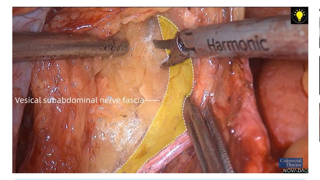 ColorectalDis's tweet image. #CoDiSundays📖☕️

@escp_tweets and @ColorectalDis watch🍿📽️🎞️  #ICG guided left lateral node dissection

#SoMe4Surgery #colorectalcancer #colorectalsurgery

@ASCRS_1 @SAGES_Updates @CRSVirtualEd @HumanitasCRS @ESSOnews 

Watch here with us👇
youtube.com/watch?v=ZgiosB…