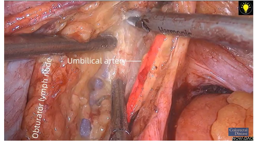 ColorectalDis's tweet image. #CoDiSundays📖☕️

@escp_tweets and @ColorectalDis watch🍿📽️🎞️  #ICG guided left lateral node dissection

#SoMe4Surgery #colorectalcancer #colorectalsurgery

@ASCRS_1 @SAGES_Updates @CRSVirtualEd @HumanitasCRS @ESSOnews 

Watch here with us👇
youtube.com/watch?v=ZgiosB…