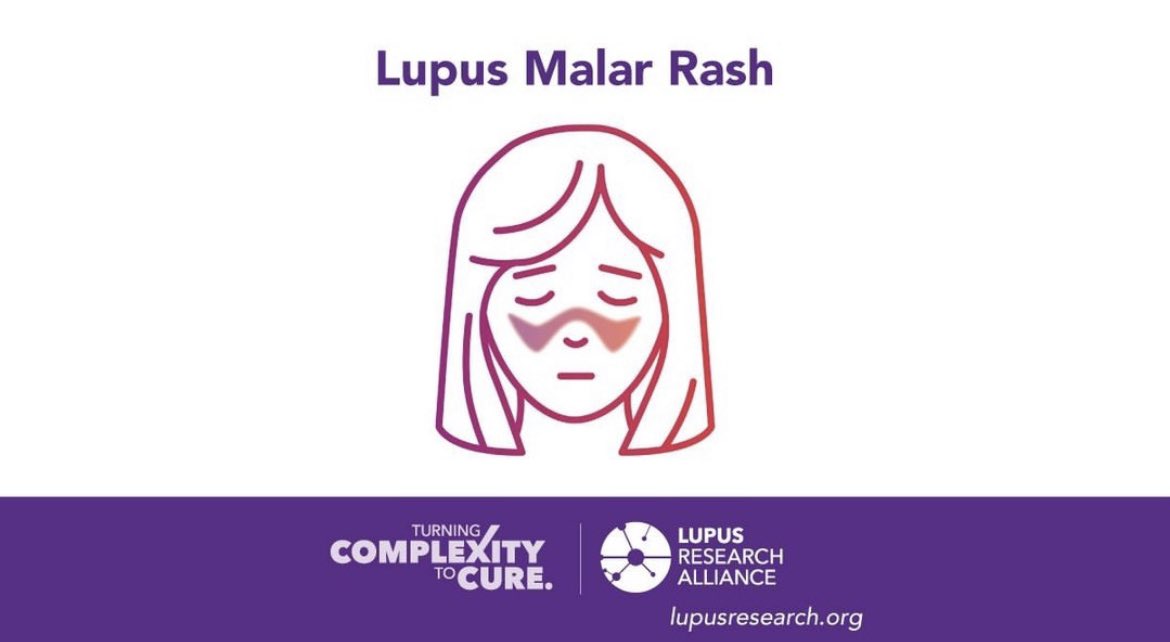 About half of people with lupus experience a characteristic red “malar” rash that may appear across the cheeks and bridge of the nose in the shape of a butterfly. People also find that the appearance of the butterfly rash is a sign of an oncoming flare: bit.ly/lupussymptoms