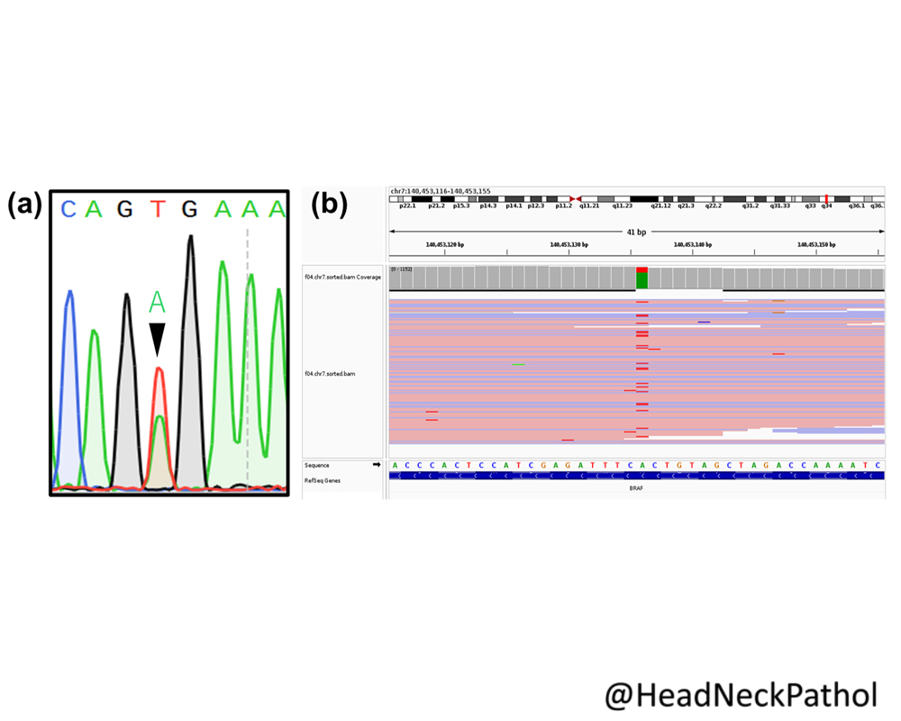 Adenoid Ameloblastoma with BRAF p.V600E Mutation Revealing Ameloblastomatous Origin: A First Case Report Y Noda, S Sawada, T Sakagami, Y Kojima, K Higasa & K Tsuta rdcu.be/dcO1W #HeadNeckPathol #HNPJ #HeadandNeckPath #Pathology #ENTPath #PathologyTweet