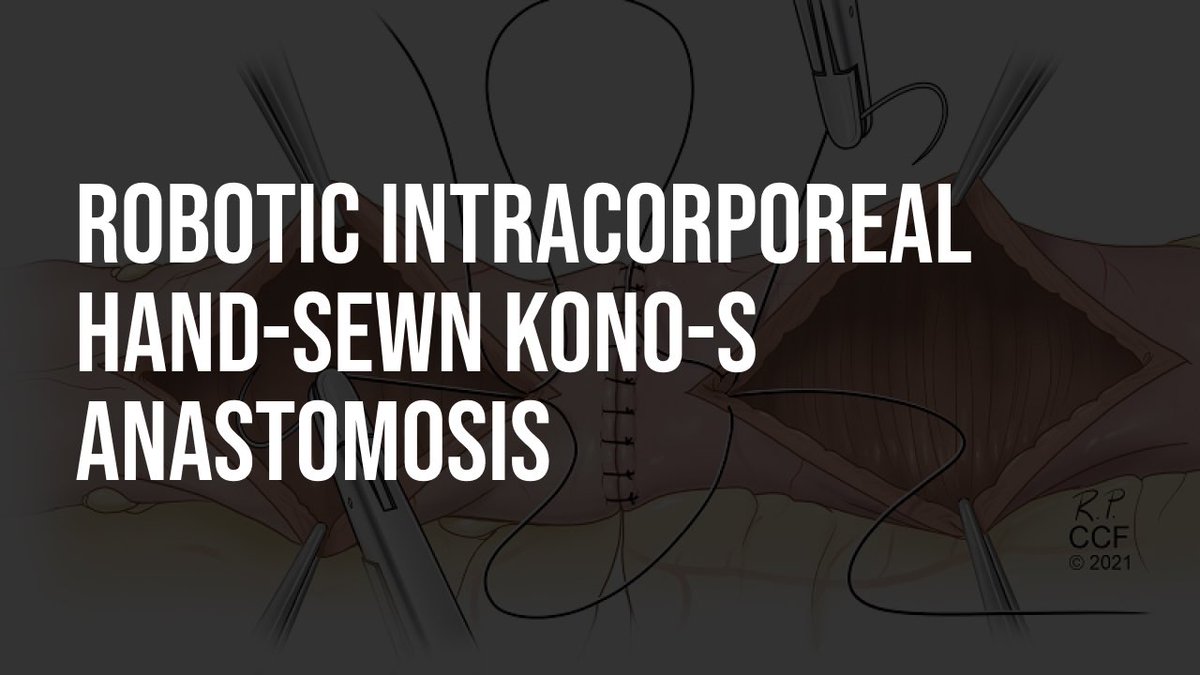 NEW VIDEO: Robotic Hand-Sewn Kono-S Anastomosis, the what, why, and how. 

youtu.be/Bq5CSoLaqOU