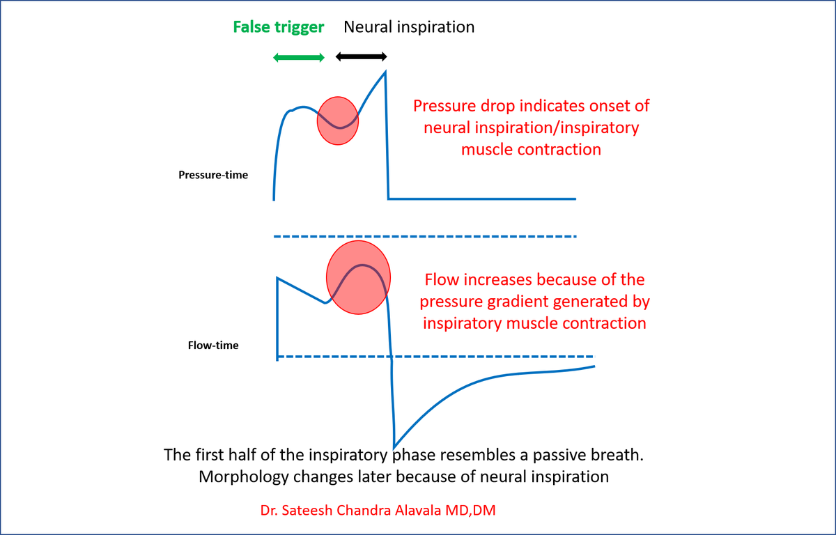DrSateeshPCCM's tweet photo. In cases where a patient exerts minimal inspiratory effort, the flow-time scalar usually displays an exponential decay, while the pressure remains constant throughout the inspiratory phase in pressure support mode. A similar appearance can also be observed during false trigger. https://t.co/0JFuNkLB6N