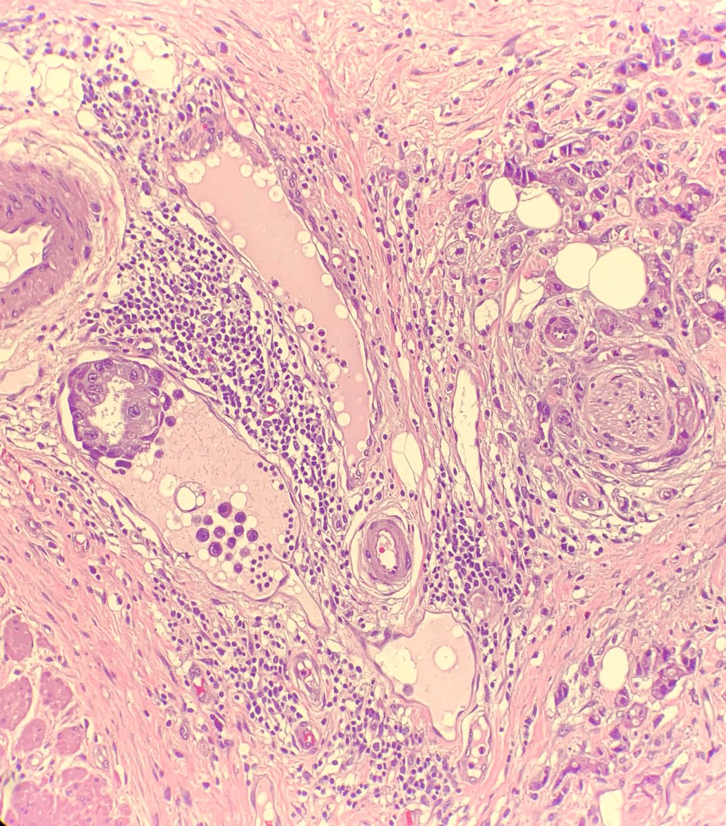 Gastric adenocarcinoma with lymphovascular and perineural invasion #GIPath