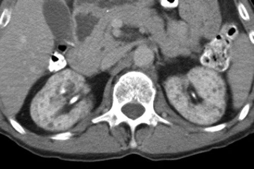 What medication toxicity causes this appearance of the kidneys? (Source: RSNA)