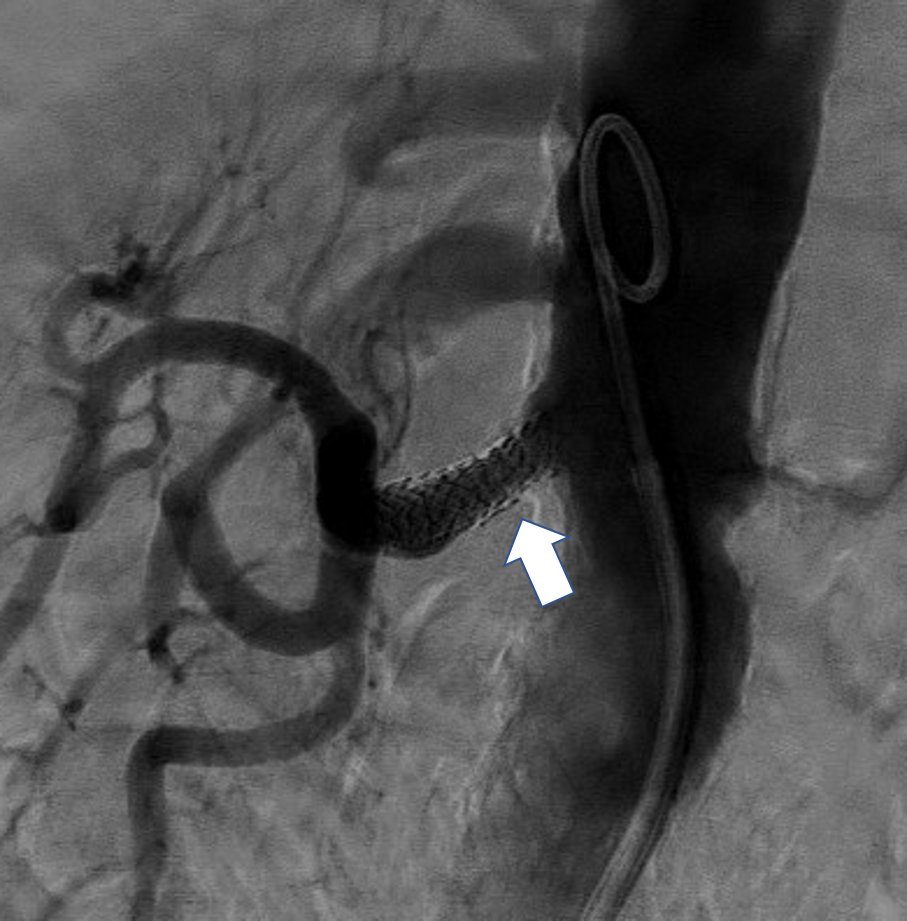 #sonography #radiology #interventionalradiology #MedTwitter
Solution to yesterday's clinical #POCUS quiz:
Severe renal artery stenosis (> 80%) due to malpositioning of the previous placed stent (fig 1 & 2).
A new stent placed proximally solved the picture (fig3)