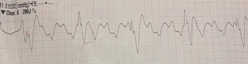 1/
Our EMS is sent for a 20yo male.
OHCA, context of RTA.
On arrival, it isn't a RTA...The patient just lies next to his motorbike. Non-traumatic OHCA then.
Rhythm is shockable, CPR begins.
On the 8th ES : vector change, patient goes PREM.
EtCO2 goes from 18 to 48.