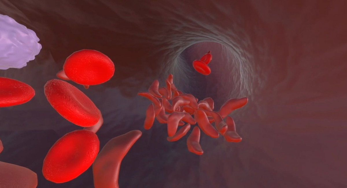 Gene Therapy (@genetherapy_sn) on Twitter photo Reported at #EHA2023, favourable safety and efficacy #clinicaltrialresults in the first four patients with #SickleCellDisease in the RUBY trial treated with EDIT-301, the world's first CRISPR/CA12 #genetherapy by <a href="/editasmed/">Editas Medicine</a>.
#GTIntheWorld Reported at #EHA2023, favourable safety and efficacy #clinicaltrialresults in the first four patients with #SickleCellDisease in the RUBY trial treated with EDIT-301, the world's first CRISPR/CA12 #genetherapy by <a href="/editasmed/">Editas Medicine</a>.
#GTIntheWorld