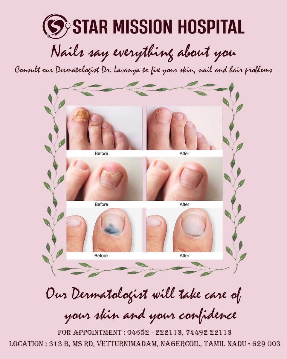Differential Diagnosis of Nail Psoriasis and Onychomycoses