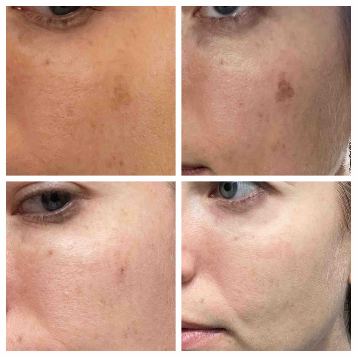 We eliminated her #hyperpigmentation with our #Quanta #Evo4 #laser. People still have laser treatments in the #summer. 😎 We do ask that you regularly reapply a good #sunscreen like #Epionce and wear a hat when out in the sun. #drannetrussell #seibellamedspa 501-228-6237