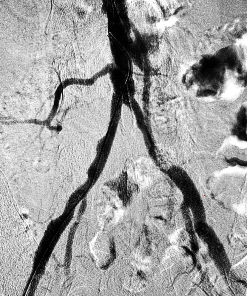 66Y/M, smoker, severe claudication left lower limb, Rutherford III, Fontaine IIb. 
No symptoms on right
Mx?Choice of stent?
.
Choices/options(below)
.
#irad #virad #radiology #radres #foamrad @TheRealDoctorOs @keithppereira @LessneVIR @vascularIR @t_intheleadcoat @SIRRFS @SIR_ECS