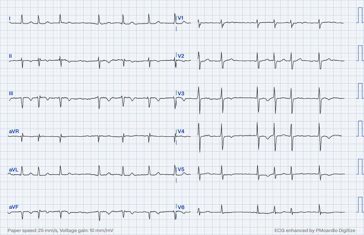 It's midnight; how would you interpret this #ECG of a 77 male ex-smoker w/ 20 minutes of thoracic pain?

• similar episode yesterday lasting 10 minutes
• initial hs-cTnT comes back 13.9 ng/L (just under the upper limit)
• patient treated with NOAC

#FOAMed #CardioTwitter