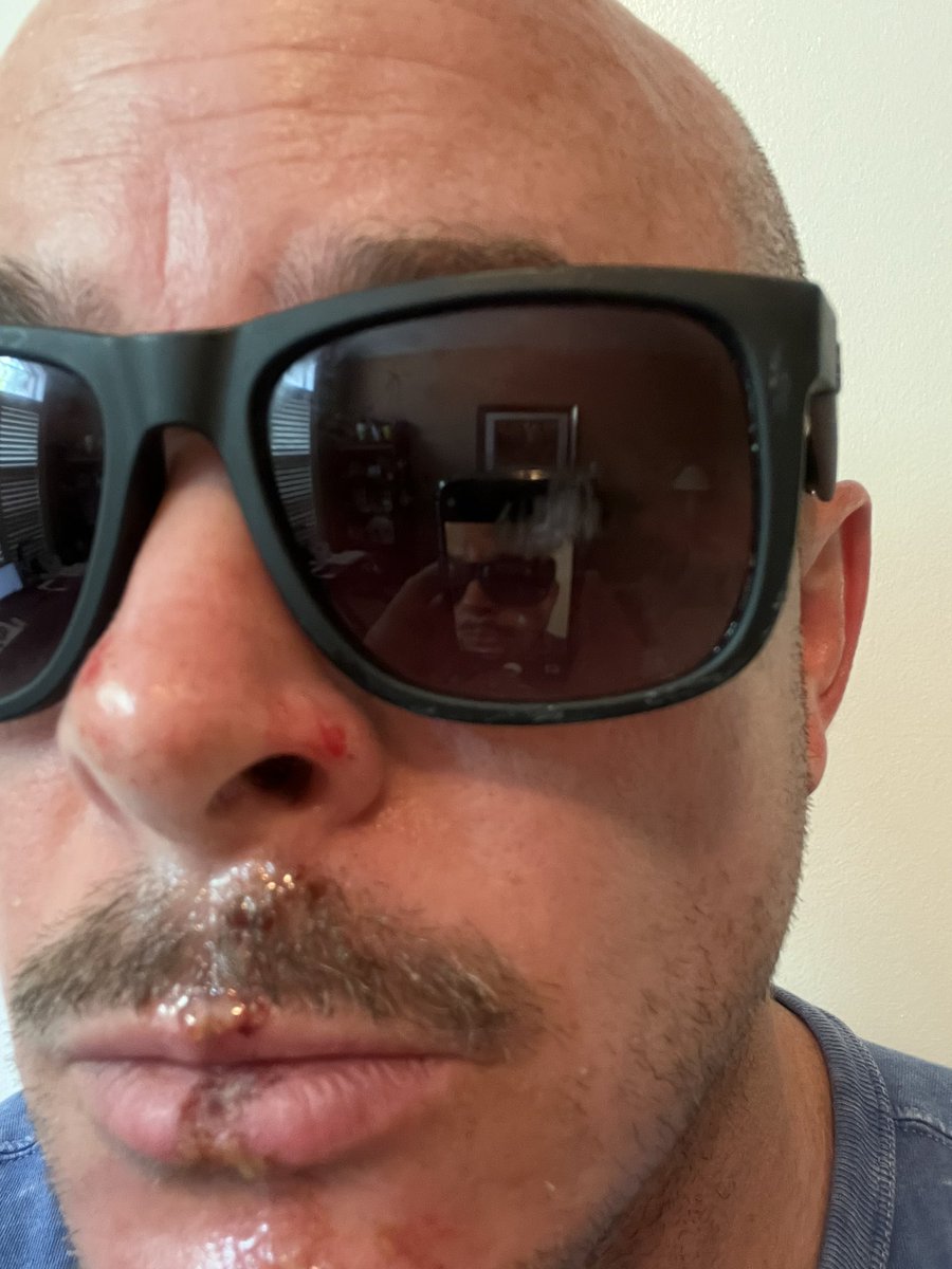 BennyJimmy's tweet photo. @ray_ban my new Justins saved some of my face! Who knows what I’d look like w/o shades and a helmet - much worse, no doubt. The lenses and frames are pretty scratched up, so there’s a new pair in my near future. Not thrilled to be out the $200, but grateful for what I did save 😎 https://t.co/buyPnobfoH