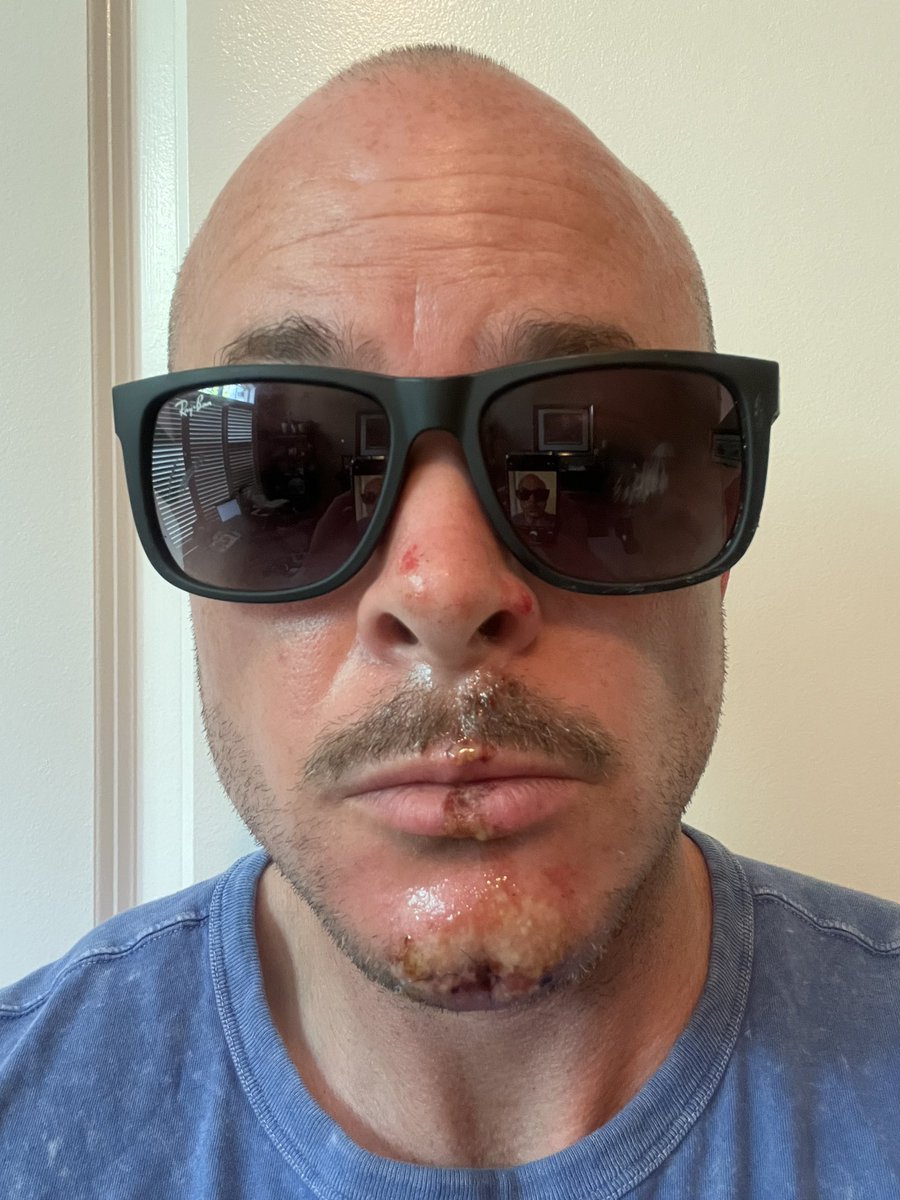 BennyJimmy's tweet photo. @ray_ban my new Justins saved some of my face! Who knows what I’d look like w/o shades and a helmet - much worse, no doubt. The lenses and frames are pretty scratched up, so there’s a new pair in my near future. Not thrilled to be out the $200, but grateful for what I did save 😎 https://t.co/buyPnobfoH