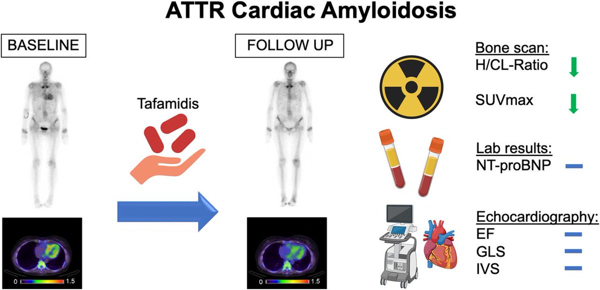 JournalofNucMed's tweet photo. Cardiac amyloidosis: ⁹⁹mTc-DPD scintigraphy may provide useful imaging biomarkers to assess response to treatment. https://t.co/Ok8jdeX2Nr

#MolecularImaging #NuclearMedicine #HeartDisease @papathanasiou_ @rischpler https://t.co/f8ntWMdhYv