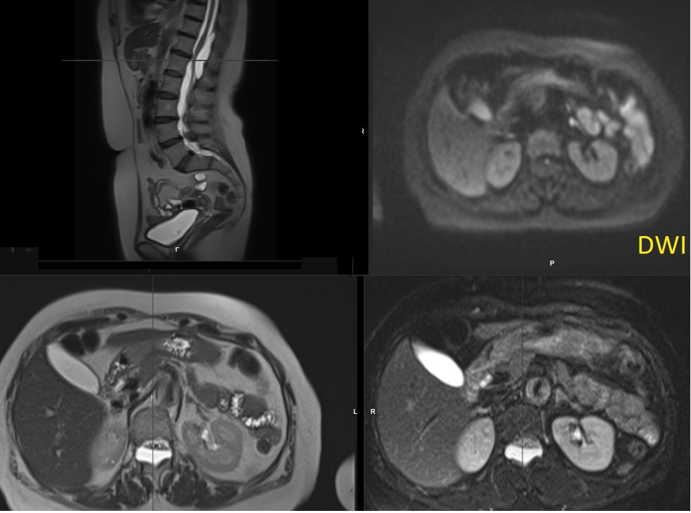 josealejandrobv's tweet image. 70y/o👩🏾‍🦳.Expansile lession w/mild mass effect on the conus medullaris&amp;amp;cauda equina. Scalloping of the posterior elements. HighT2 signal No DWI anomaly. Most likely spinal(apparently)extradural arachnoid cyst. Same date brain MR:no brain sag nor congestion #spinerad @The_ASSR