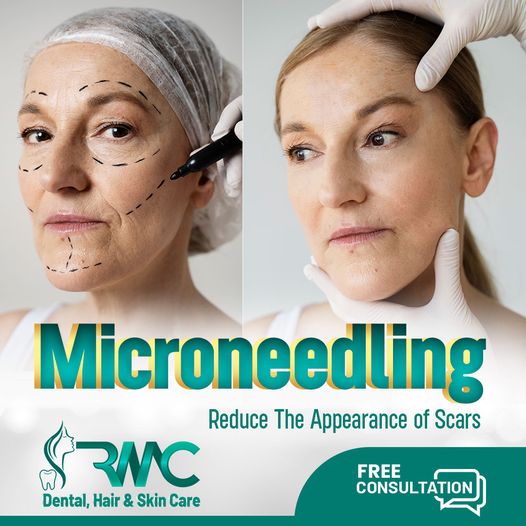 Microneedling Therapy in Islamabad | RMC
rmcskin.com/microneedling-…
#microneedling #microneedlingtherapy #microneedlingtreatments #microneedlingfacial #microneedlingbeforeandafter  #beautytok #microneedlingprp #microneedlingserum #microneedlingbenefits #microneedlingbbglow #skincare