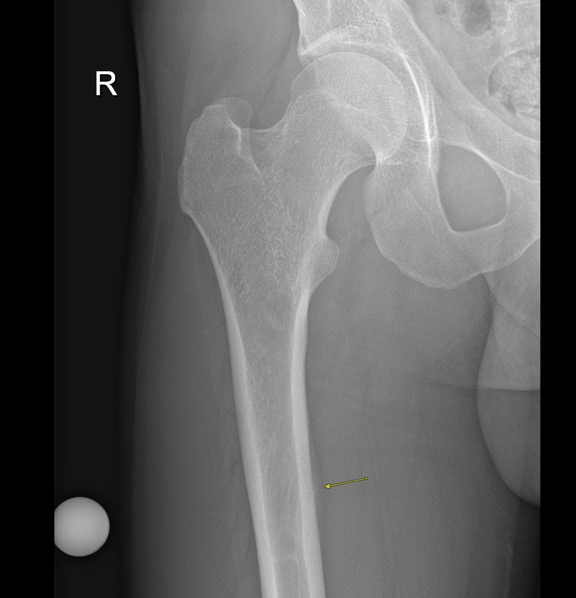 Jan Fritz on Twitter "RADIOGRAPHYMRI CORRELATION Femoral stress