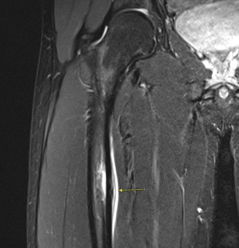 Jan Fritz on Twitter "RADIOGRAPHYMRI CORRELATION Femoral stress