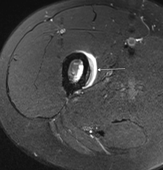 Jan Fritz on Twitter "RADIOGRAPHYMRI CORRELATION Femoral stress