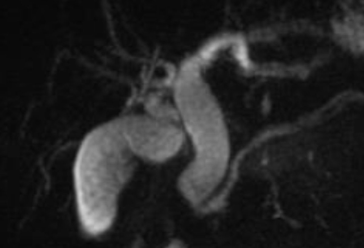 What is happening here Middle age lady with biliary colic and normal LFT. @Gastro_Hep @EndoCollabcom @DrHasan_Orlando @helpatologist @DrSaadniaz @GNTPak @drkeithsiau @ASGEendoscopy @EndoTx @AnandSahaiEUS @GIscope_updates