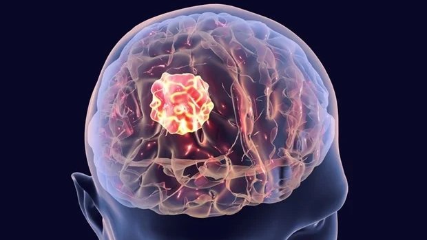 O glioblastoma é um câncer super agressivo, que afeta as células da glia, no 🧠. "Representa quase metade de todos os cânceres cerebrais malignos, e a sobrevida após o diagnóstico é, em média, de 12 a 18 meses, sendo que apenas 7% estão vivos após cinco anos" - <a href="/sailorrooscout/">Chise</a>