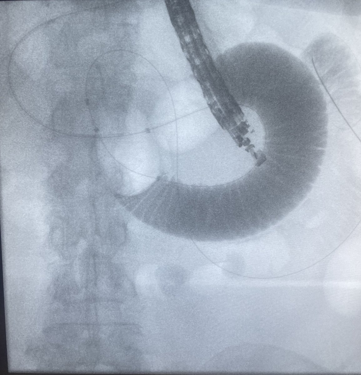 ChessMedical (@chessmedic) on Twitter photo Happy to share our novel FDA cleared through the scope exchangeable dual balloon occlusion enteroclysis catheter for targeted imaging of the small bowel. #Naja #advancedendoscopy @yeni_mtl
Inquiries: chessmedic@gmail.com Happy to share our novel FDA cleared through the scope exchangeable dual balloon occlusion enteroclysis catheter for targeted imaging of the small bowel. #Naja #advancedendoscopy @yeni_mtl
Inquiries: chessmedic@gmail.com
