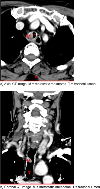 BJAJournals's tweet photo. We have a fantastic review article on the role of #ECMO for airway procedures in #BJAEducation - read here:

#ECMO #criticalcare #anaesthesia 
https://t.co/Jg1J0J3XWh https://t.co/mk35jRkPHd