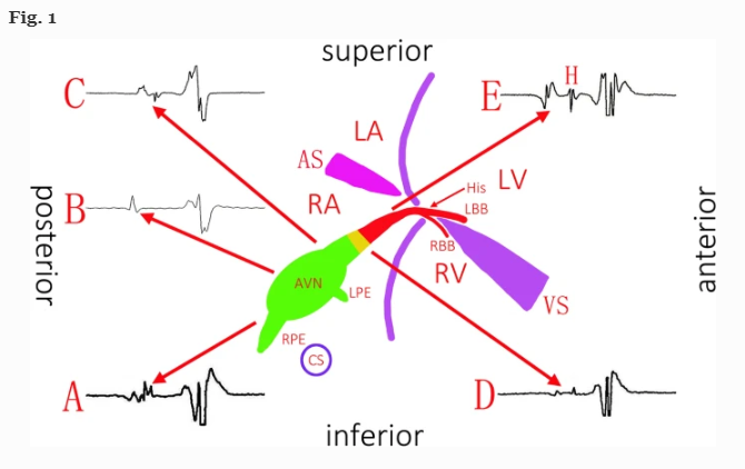 JICE_EP's tweet image. 🚨Latest #FreeRead Article in @JICE_EP

The Underrecognized &amp;amp; Neglected Compact AV Nodal Potential: Clinical Significance for Preventing AV Block during So-Called Slow Pathway RF Ablation

by C Di, Q Wang, Y Wu, L Li &amp;amp; W Lin

📖🧐Read it here:  rdcu.be/deSGb

#EPeeps