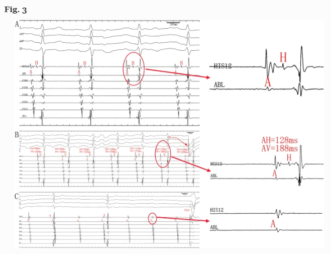 JICE_EP's tweet image. 🚨Latest #FreeRead Article in @JICE_EP

The Underrecognized &amp;amp; Neglected Compact AV Nodal Potential: Clinical Significance for Preventing AV Block during So-Called Slow Pathway RF Ablation

by C Di, Q Wang, Y Wu, L Li &amp;amp; W Lin

📖🧐Read it here:  rdcu.be/deSGb

#EPeeps