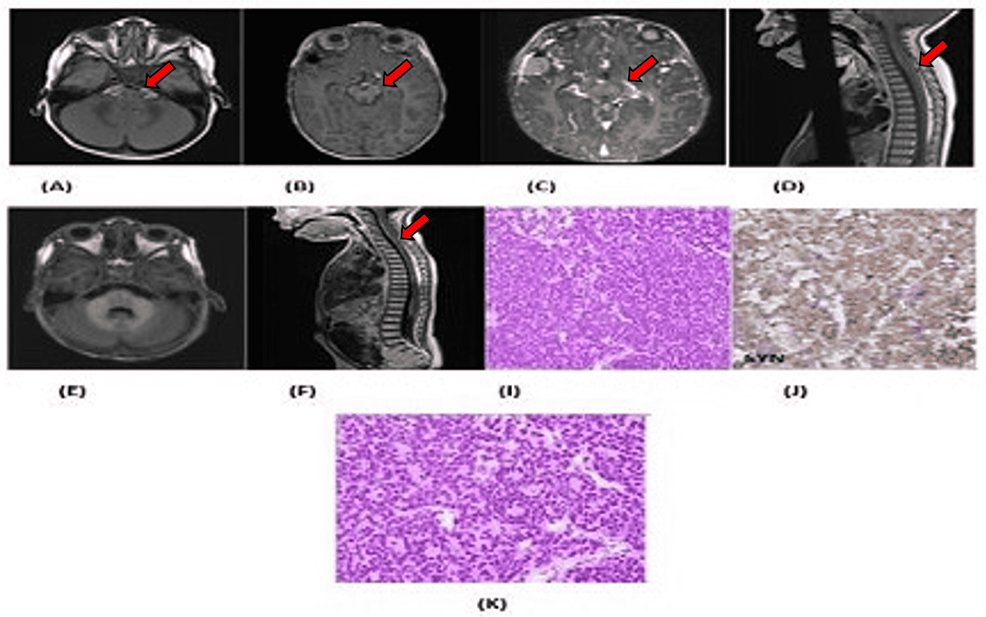 🧑‍⚕️Revolutionizing cancer care! Discover how #VirtualTumorBoards are streamlining multidisciplinary collaboration for better patient outcomes! 🔗 bit.ly/3Jp3WH5 🔬🧠 #MedTech #CancerResearch #GliomaTreatment #BrainCancer #HealthcareInnovation