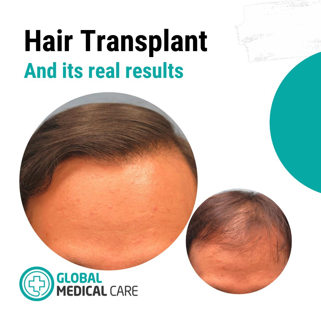Our patient was operated on by experienced doctors using 4in1 method to ensure fast recovery and natural results. #hairtransplant #hairtransplantation #hairtransplantistanbul #hairtransplantturkey #hairtransplantforwomen #beardtransplant #beardtransplantturkey