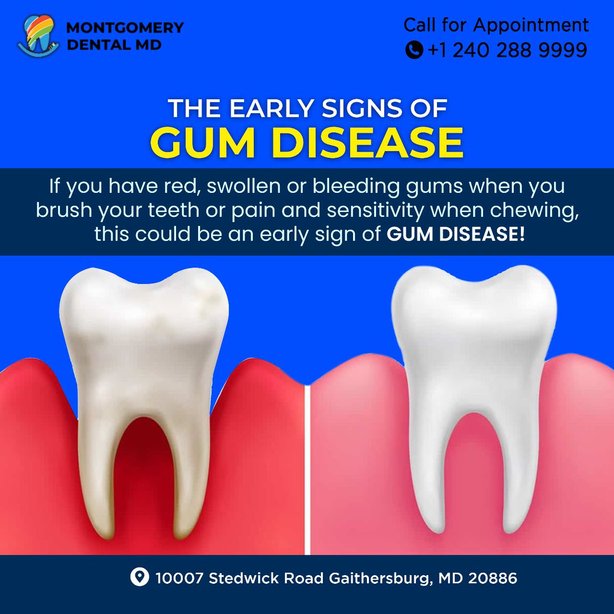 MontgomeryDent4's tweet photo. Maintain good oral hygiene to prevent the early stages of gum diseases.
.
Book an appointment: 240-288-9999 or
Visit: https://t.co/J8Y32I8o5u
.
#dentistry #gumdisease #gingivitis #teethsensitivity #bestdentistingaithersburg #smile #tooth #montgomerydentalmd #usa #gaithersburg https://t.co/NjcFMtlEtr
