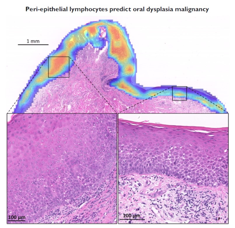 Excited to share our collab paper in <a href="/jpathol/">jpathol</a> with @nmrajpoot and <a href="/isaadbashir/">Raja Muhammad Saad Bashir</a> reporting first use of deep-learning for prognosis prediction of Oral-Epithelial-Dysplasia.

tinyurl.com/26adu6b3 

Funding- <a href="/CR_UK/">Cancer Research UK</a> <a href="/NIHRresearch/">National Institute for Health and Care Research</a> <a href="/uniofwarwick/">University of Warwick</a> 
#earlydetection #headandneckcancer