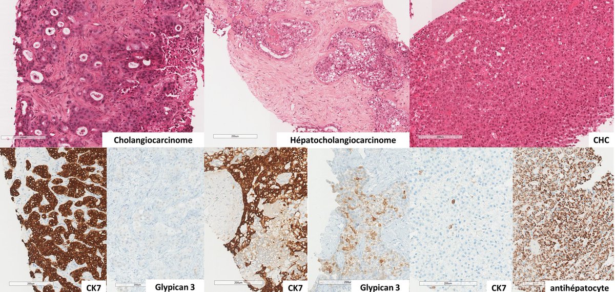 Bernoulli_Lab (@bernoulli_lab) on Twitter photo <a href="/Bernoulli_Lab/">Bernoulli_Lab</a> vous présente le projet CLASSTHEP, qui travaille à une classification automatisée des tumeurs intrahépatiques à partir de biopsies de routine, collaboration <a href="/fhu_mosaic/">FHU MOSAIC</a> / équipe OPIS <a href="/Inria_Saclay/">Centre Inria de Saclay</a> <a href="/centralesupelec/">CentraleSupélec</a> bernoulli-lab.fr/project/classt… <a href="/Bernoulli_Lab/">Bernoulli_Lab</a> vous présente le projet CLASSTHEP, qui travaille à une classification automatisée des tumeurs intrahépatiques à partir de biopsies de routine, collaboration <a href="/fhu_mosaic/">FHU MOSAIC</a> / équipe OPIS <a href="/Inria_Saclay/">Centre Inria de Saclay</a> <a href="/centralesupelec/">CentraleSupélec</a> bernoulli-lab.fr/project/classt…