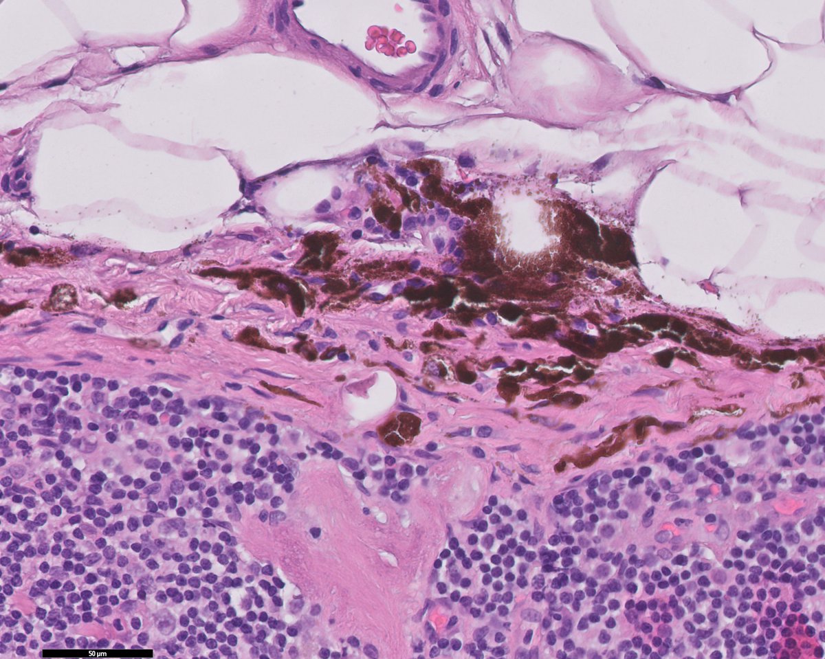 RyCPatologia's tweet photo. ➡️ Paciente con carcinoma lobulillar infiltrante de mama.
➡️ Ganglio linfático centinela axilar.
🔬 Nevus melanocítico capsular.
#rycpath #hemepath #breastpath https://t.co/qIK0hpXFD5