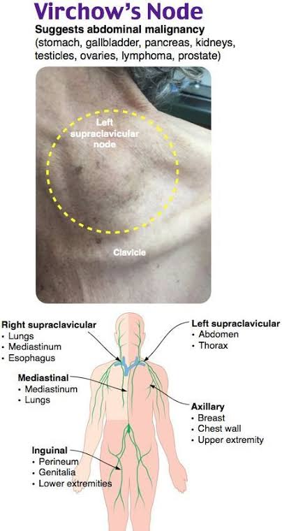 <a href="/BrownJHM/">Journal of Brown Hospital Medicine</a> <a href="/drkeithsiau/">Keith Siau</a> The Troisier sign represents an enlargement of a left-sided supraclavicular lymph node. The enlarged supraclavicular lymph node is known as a Virchow node (VN), Troisier node, or Virchow-Troisier node