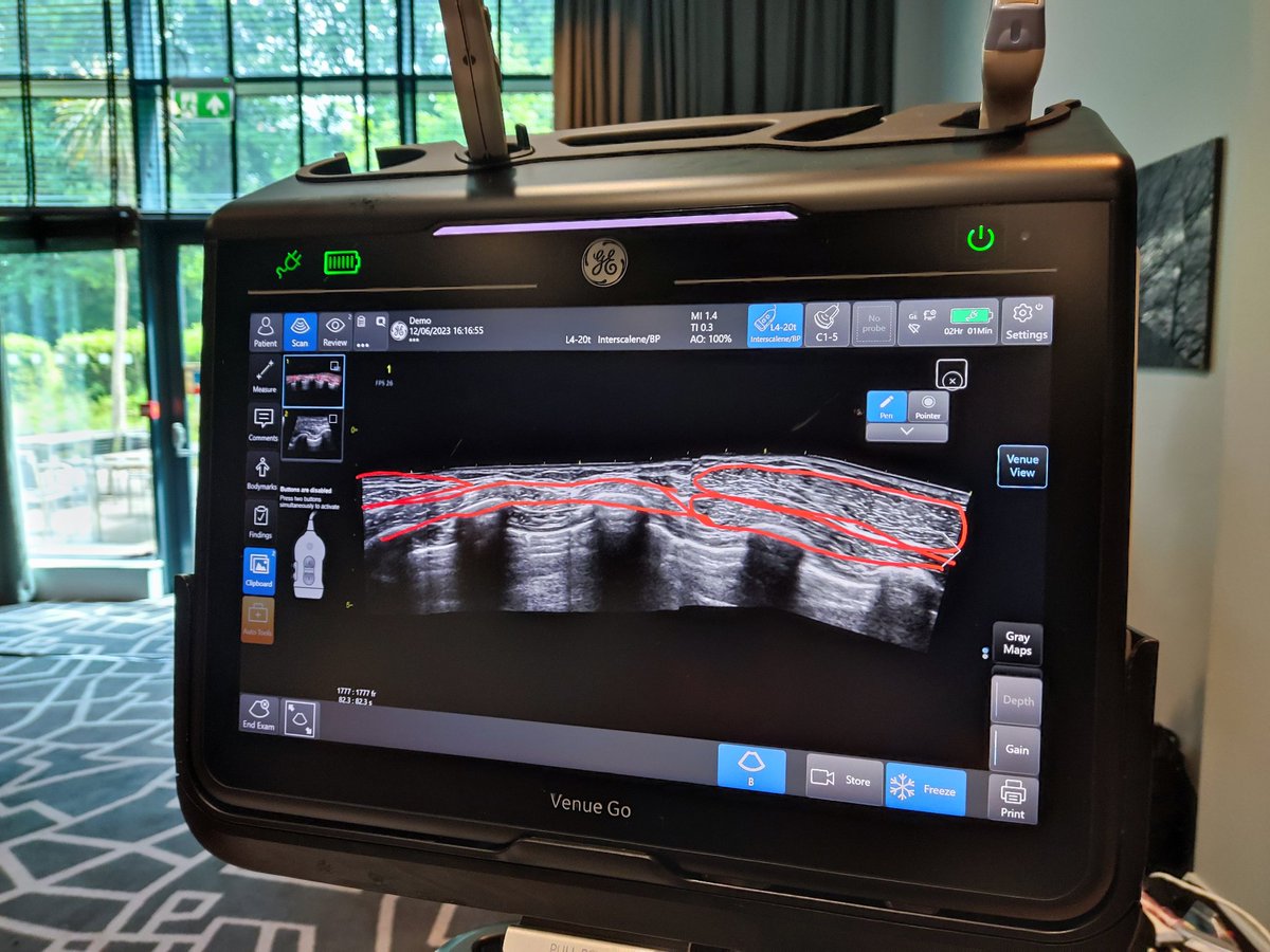 MadanNarayanan's tweet photo. Beautiful panoramic view with drawing @GEHealthCare in our catheter course. https://t.co/EEyNsPDTZE